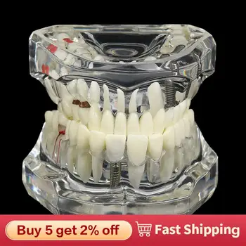 Ochorenia Zubov Model S Obnovy Mosta Zubov Zubný Lekár Pre Lekárske Vedy Zubné Ochorenia Učiteľské Študijné Zubný Implantát